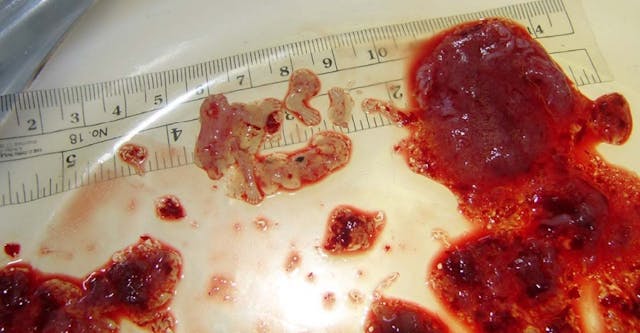 NAF Slide first trimester abortion. Visible are arms and hands. USF Articles only Image: NAF Slide products of conception from abortion