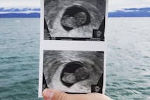 miscarriage, miscarried, ultrasound
