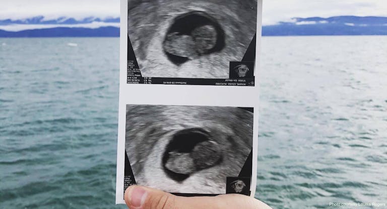 miscarriage, miscarried, ultrasound
