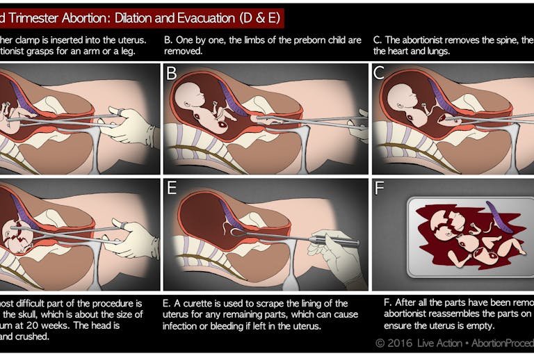 D&E abortion: the facts in pictures