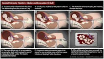 D&E abortion: the facts in pictures
