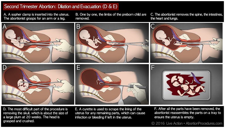 D&E abortion: the facts in pictures