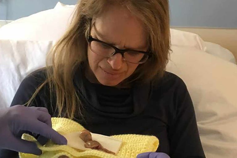 Baby-miscarried-at-13-weeks