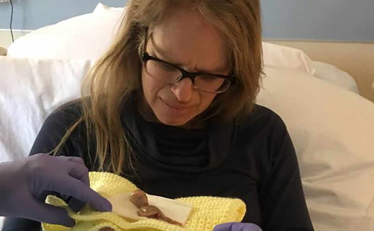 Baby-miscarried-at-13-weeks
