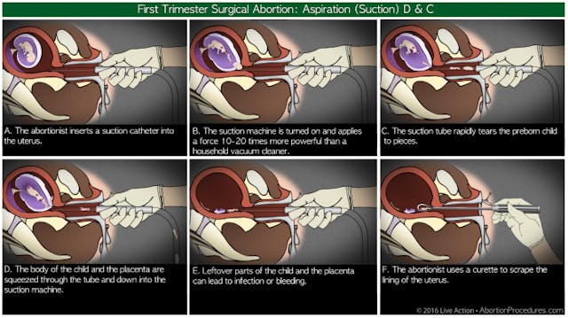 Suction D & C 6 panel