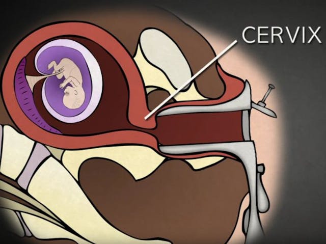Dilating cervix in 1st trimester surgical abortion (abortionprocedures.com)