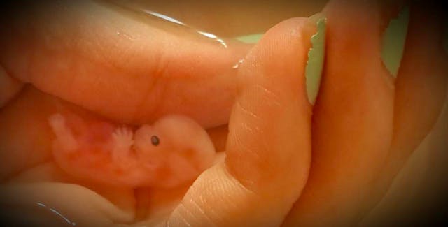 Annabelle, at 8 weeks, 5 days old. Her mother shared her beautiful story and photos here, illustrating the absolute humanity of all preborn children.