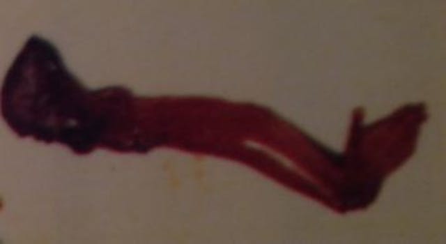 Aborted baby arm 2