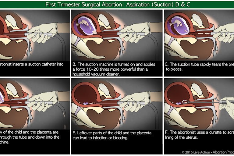 Suction D & C 6 panel