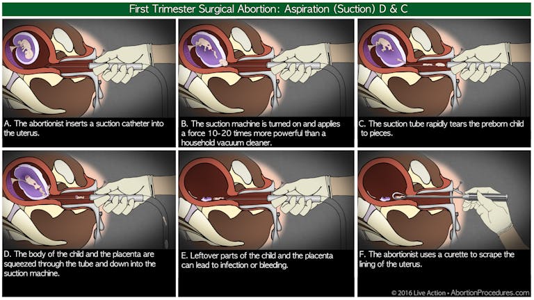 Suction D & C 6 panel
