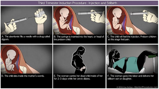 Third Trimester induction diagram 6 panel