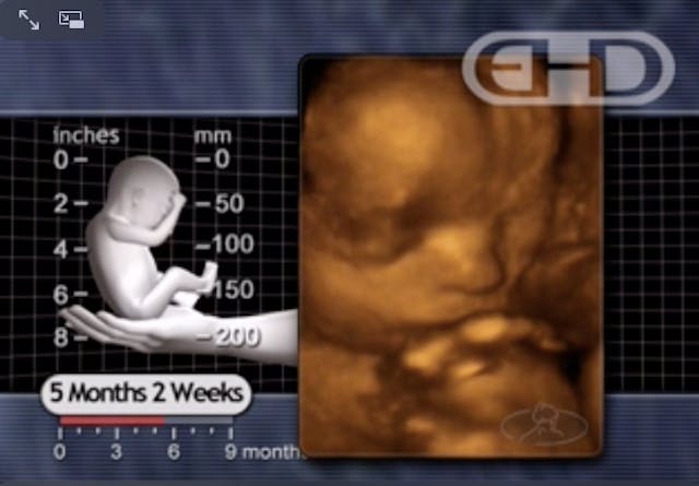 born alive, 22 weeks
