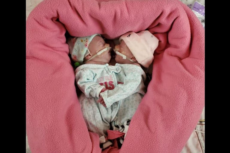 conjoined twins, hickey twins, via facebook