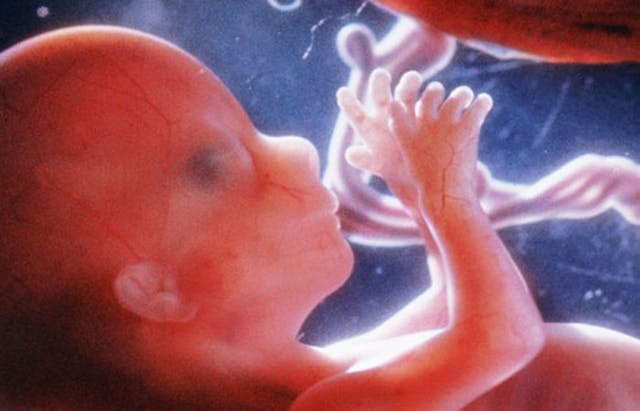 16 weeks abortions, D&E, preborn, how abortion works, pro-life, abortion, Preborn human at about 16 weeks - estimated time of the attempted abortion of Elisa.