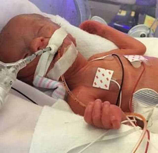 Born premature at 29 weeks, Hannah Joy thrived against all odds image