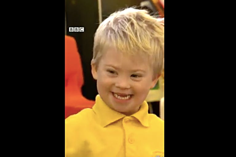 Down syndrome