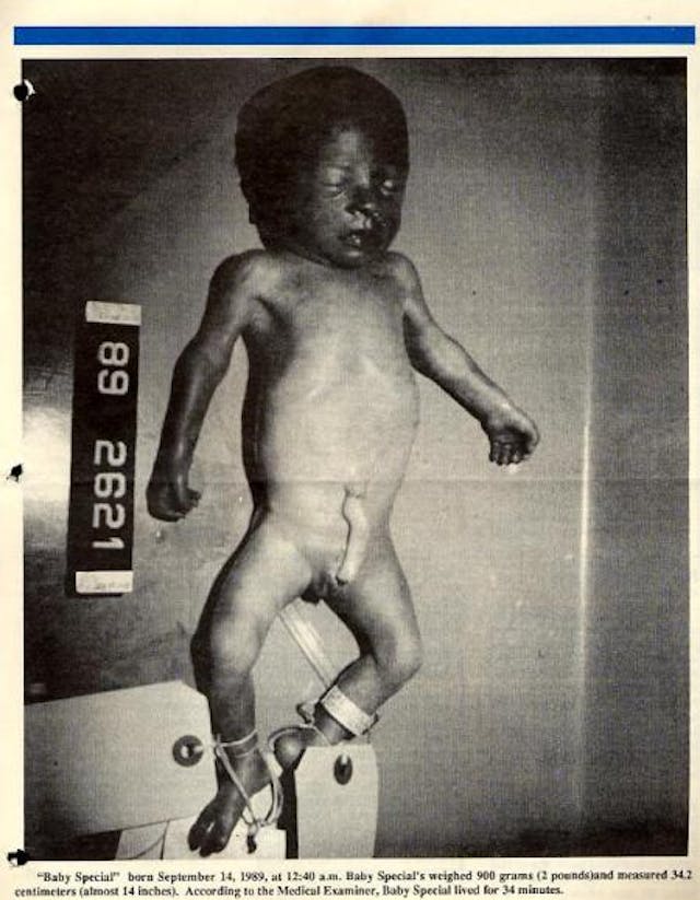 Baby Special Babies have accidentally survived abortions for decades. Here’s proof. image