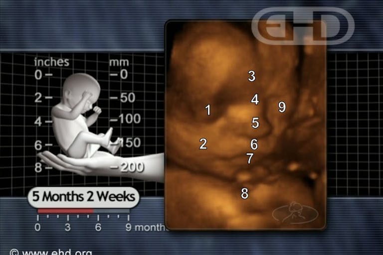abortion, prenatal