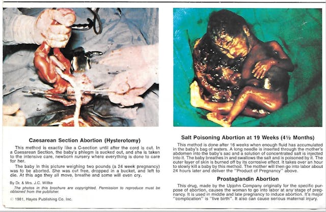 Hysterotomy abortion and Saline or Prostaglandin abortion (Image: pamphlet Life or Death Hayes Publishing) Image: Hysterotomy and Saline or Prostaglandin abortion procedures (Image: pamphlet Life or Death Hayes Publishing)