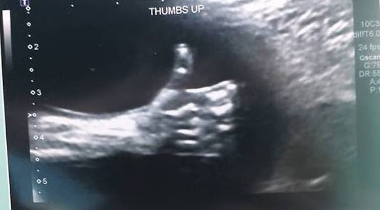 thumbs-up-ultrasound