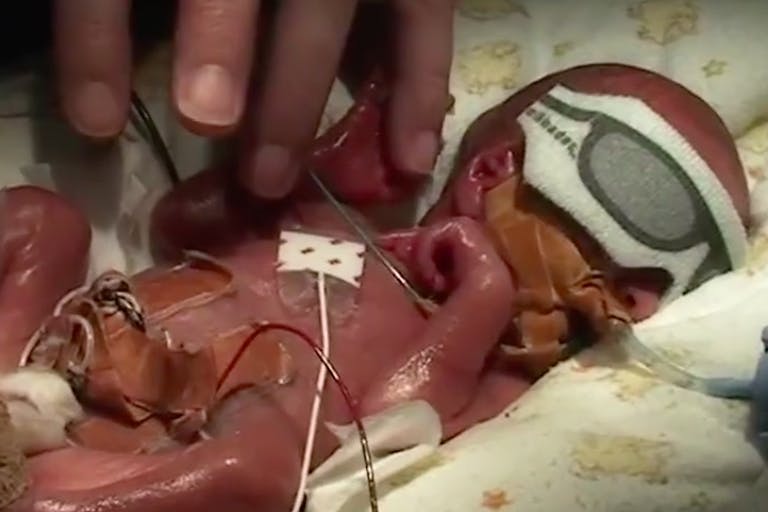 abortion, baby Toby, premature