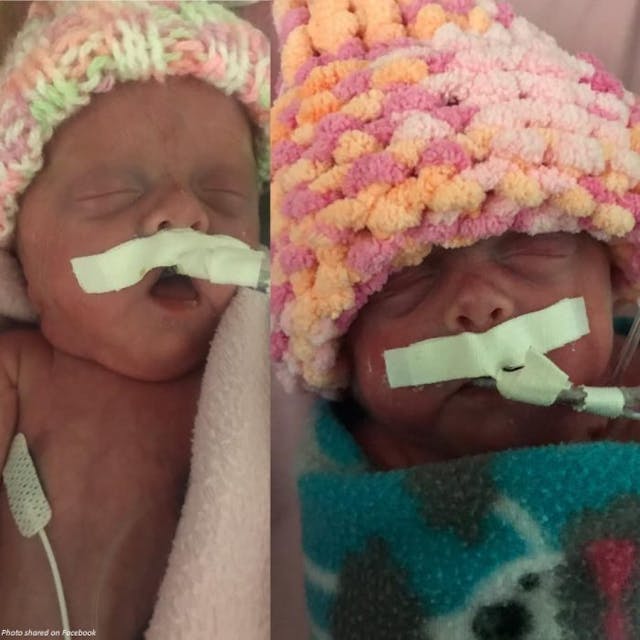 Miracle twins survive rare prenatal syndrome, defy odds image