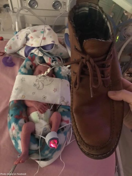 Miracle twins survive rare prenatal syndrome, defy odds image