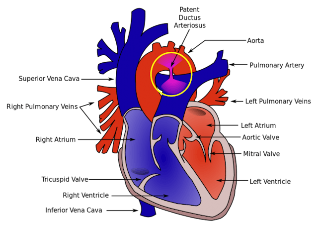 A PDA defect (Source: Wikimedia Commons) Premature babies get a new chance at life thanks to this amazing device image