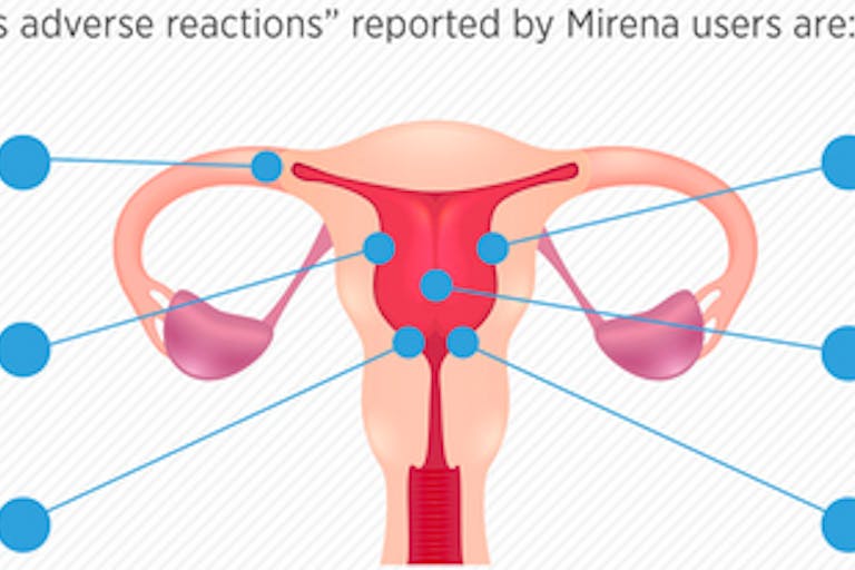 Mirena IUD