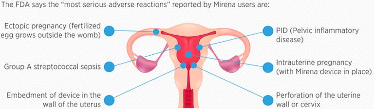 Mirena IUD