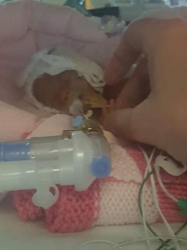 Baby Sussie was born premature at about the size of a candy bar. facebook