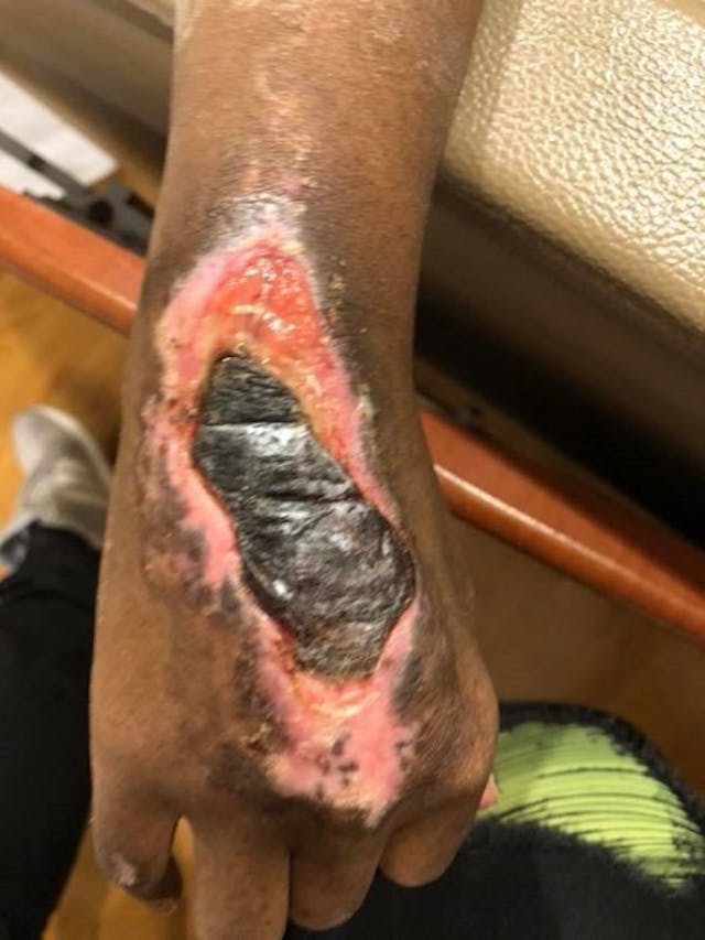 Tanai Smith’s hand after her IUD migrated and surgery to remove it led to sepsis. Tanai Smith's hand after her IUD migrated and surgery to remove it led to sepsis.