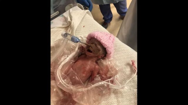 Family praises medical staff for saving 24-week preemie in Northern Ireland image