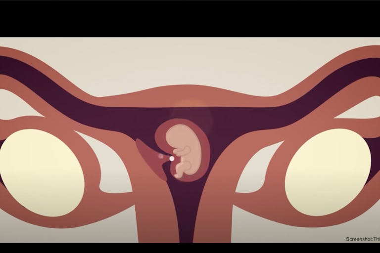 chemical abortion, abortion pill