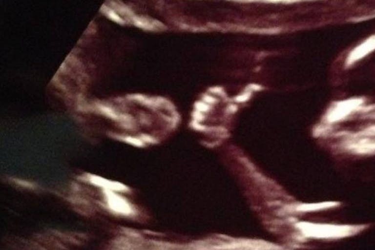 Ultrasound Baby Fetus Thumbs Up