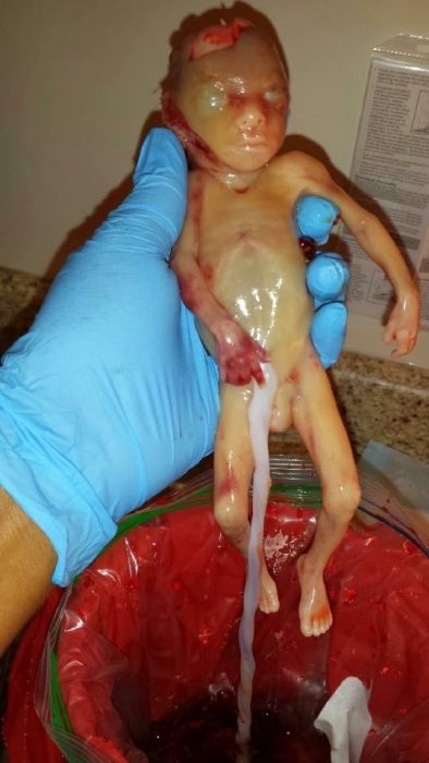 Image of aborted baby allegedly shared by abortion clinic worker