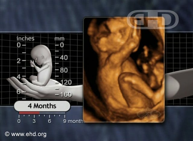 4-month ultrasound and clinical illustration
