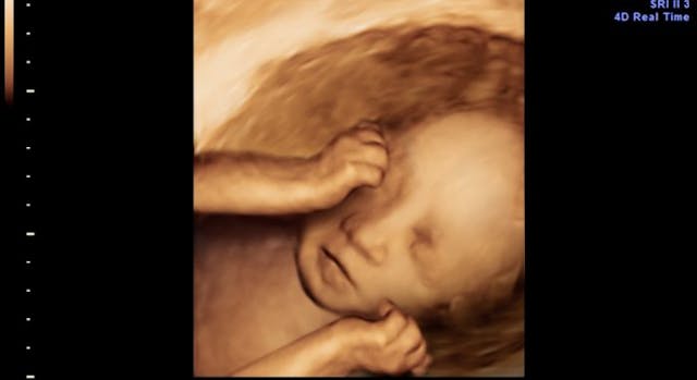 4D scan of IVF baby in womb, 28 weeks 2 days 28 week abortion pill death