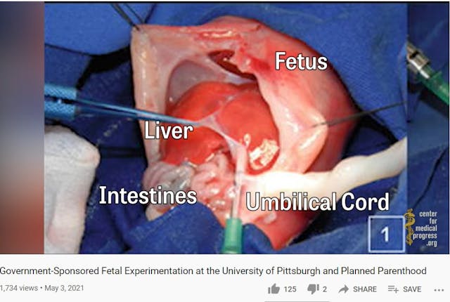 University of Pittsburgh uses live aborted babies in study (Image: Center for Medical Progress video) Image: University of Pittsburgh uses live aborted babies in study (Image: Center for Medical Progress video)