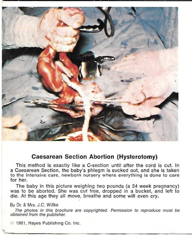 Hysterotomy abortion (Image: Death or Life Brochure by Hayes Publishing 1981) Image: Hysterotomy abortion (Image: Death or Life Brochure by Hayes Publishing 1981)