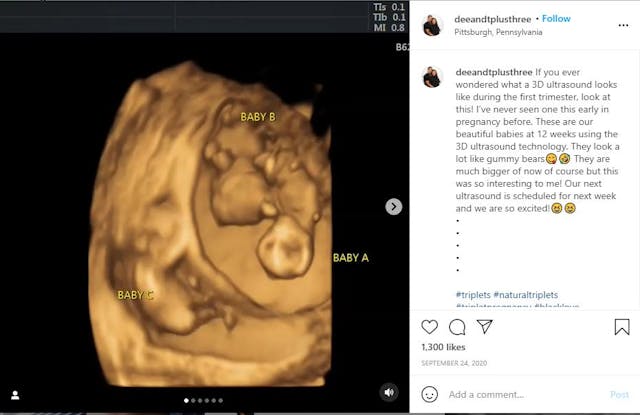 Conceiving while pregnant: Families shocked at news of triplets conceived days apart image