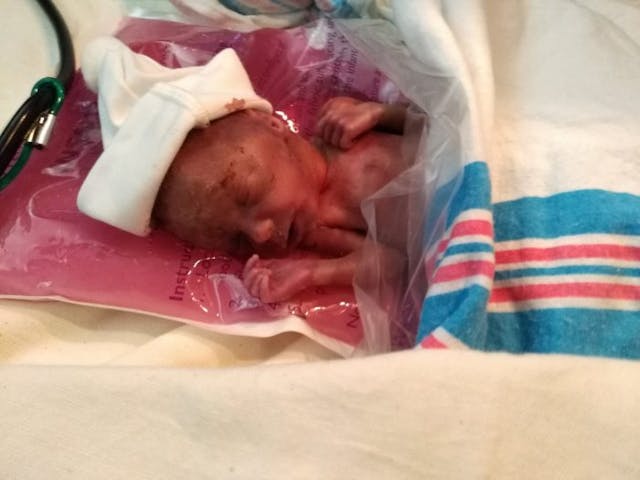 Baby Benson Benson, born premature at 22 weeks, is home from the hospital image