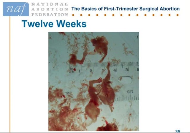 NAF Slide products of conception abortion at 12 weeks Image: NAF Slide products of conception abortion at twelve weeks