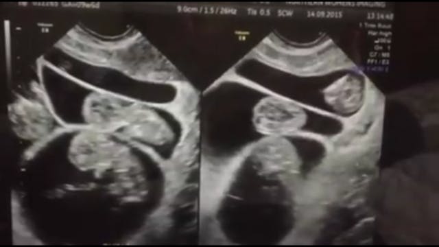 Screenshot from ultrasound video on Facebook. Screenshot 2016-02-03 06.39.02