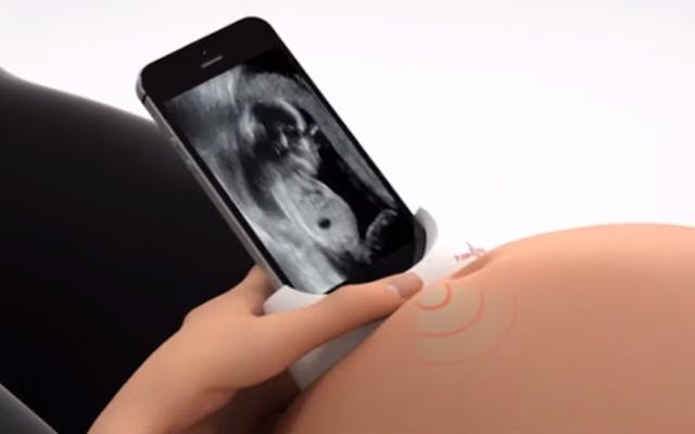 Amazing: New ultrasound device lets moms see their babies using smartphones image