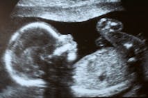 Photo: Getty Images Mexico, abortion, ultrasound