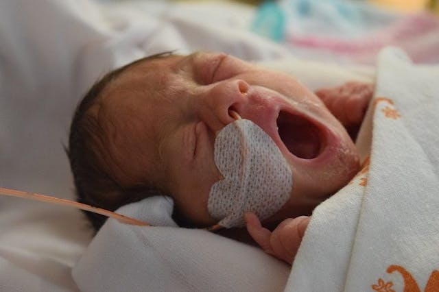 Baby Petra yawns in the NICU after her premature birth. Photo courtesy of Staycie Kirkendall. Petra was a premature baby.
