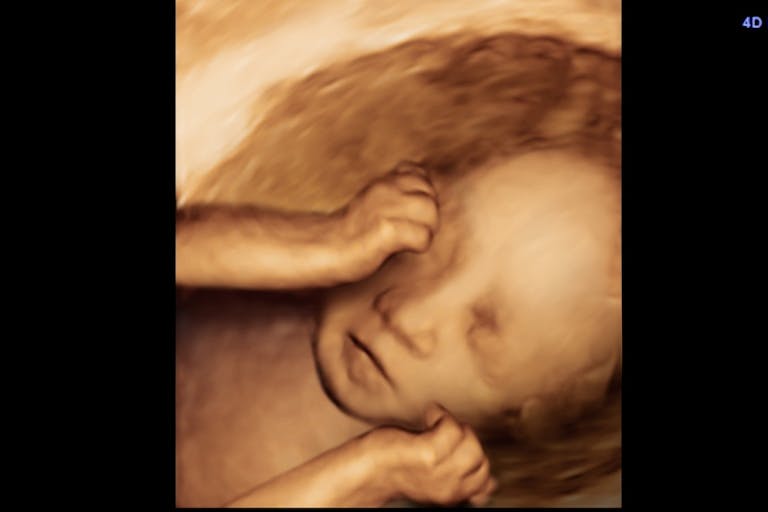 28 week abortion pill death, third-trimester