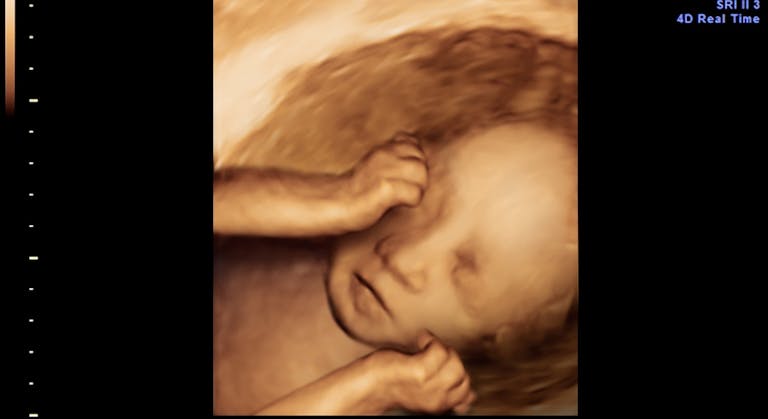 28 week abortion pill death, third-trimester