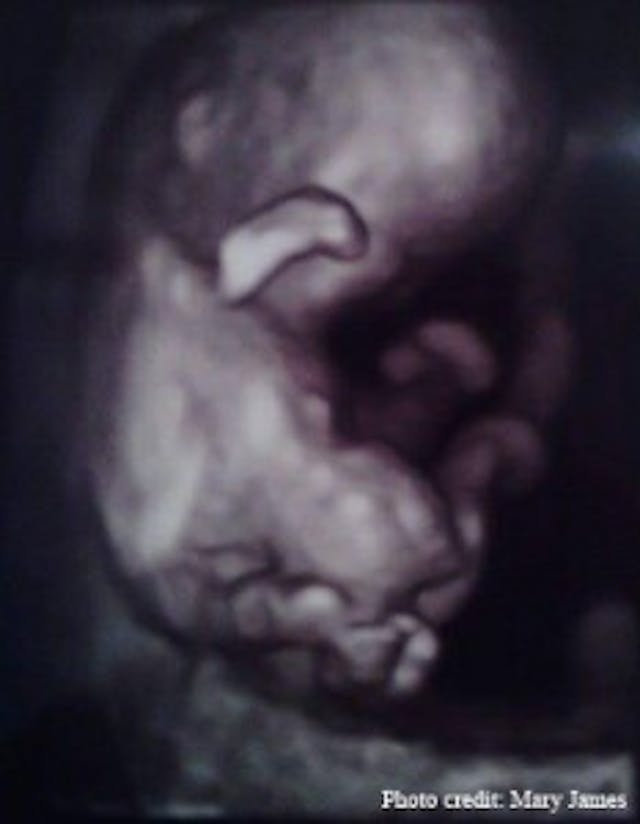Mary-James-Charlie-ultrasound